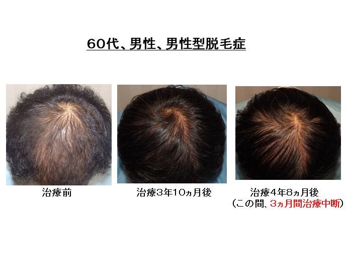 円形脱毛症　名医""
